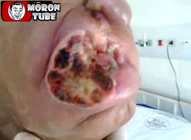 Video :A severe instance of oral leishmaniasis (publicly notified)